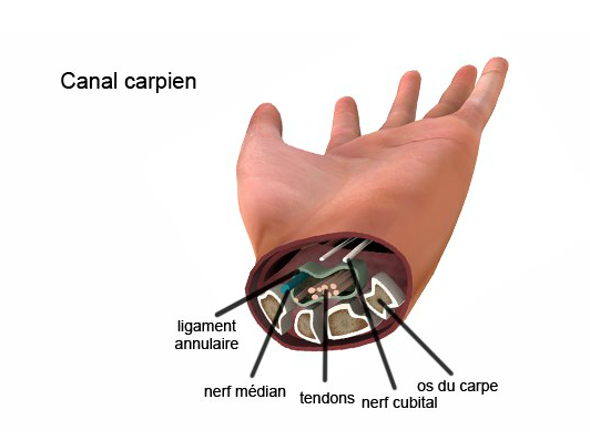 TMS et syndrome du canal carpien